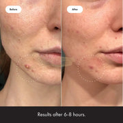 Hero Mighty Patch Invisible Anti-Acne