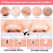 USB Rechargeable Ultrasonic Skin Scrubber Blackhead Remover | Pore Cleansing Facial Device for Clear Skin Skin Care